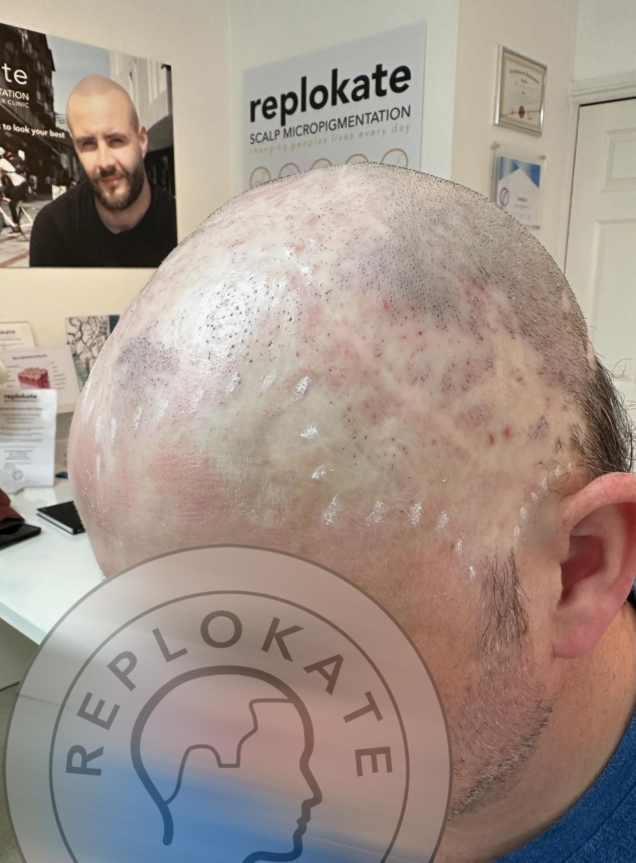 Replokate Scarring Treatment in Bristol