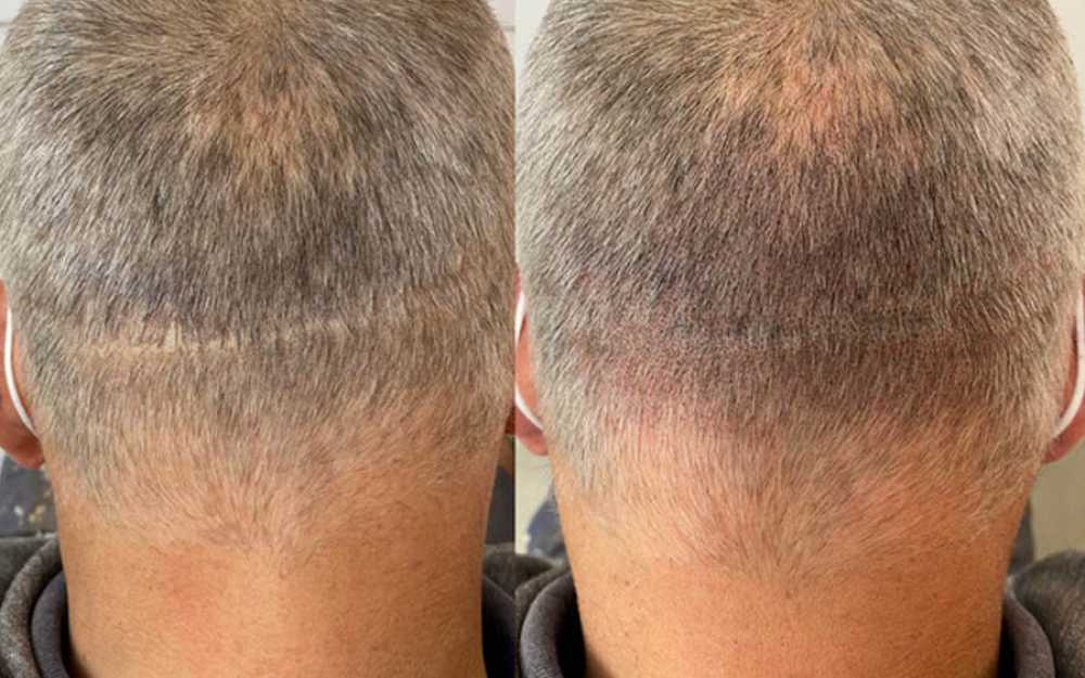 Before & After SMP Treatment #11