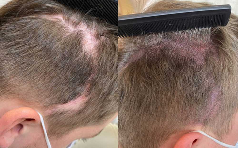 Before & After SMP Treatment #12