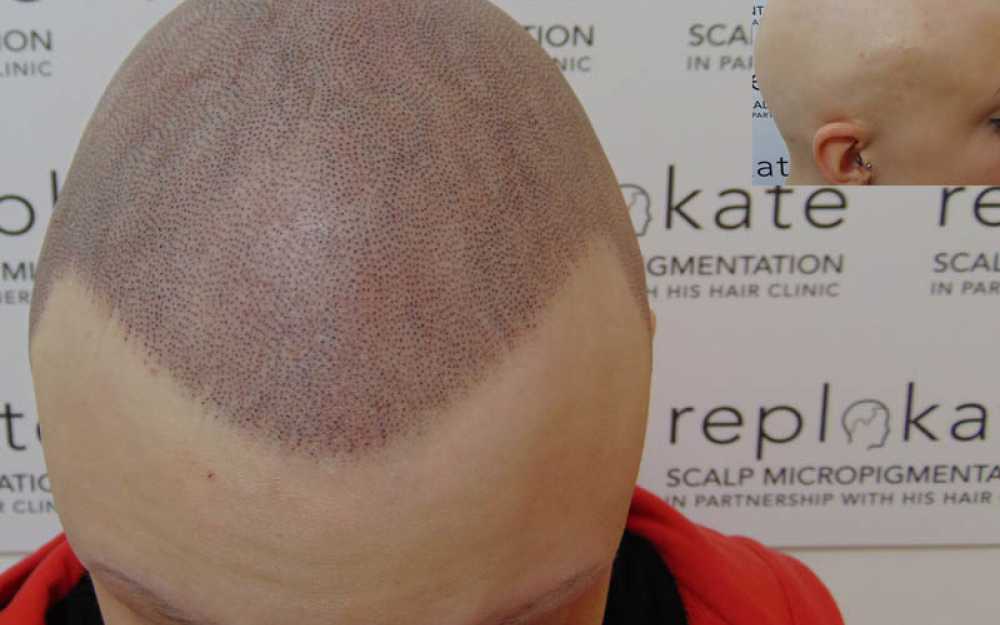SMP Treatment for Alopecia #1