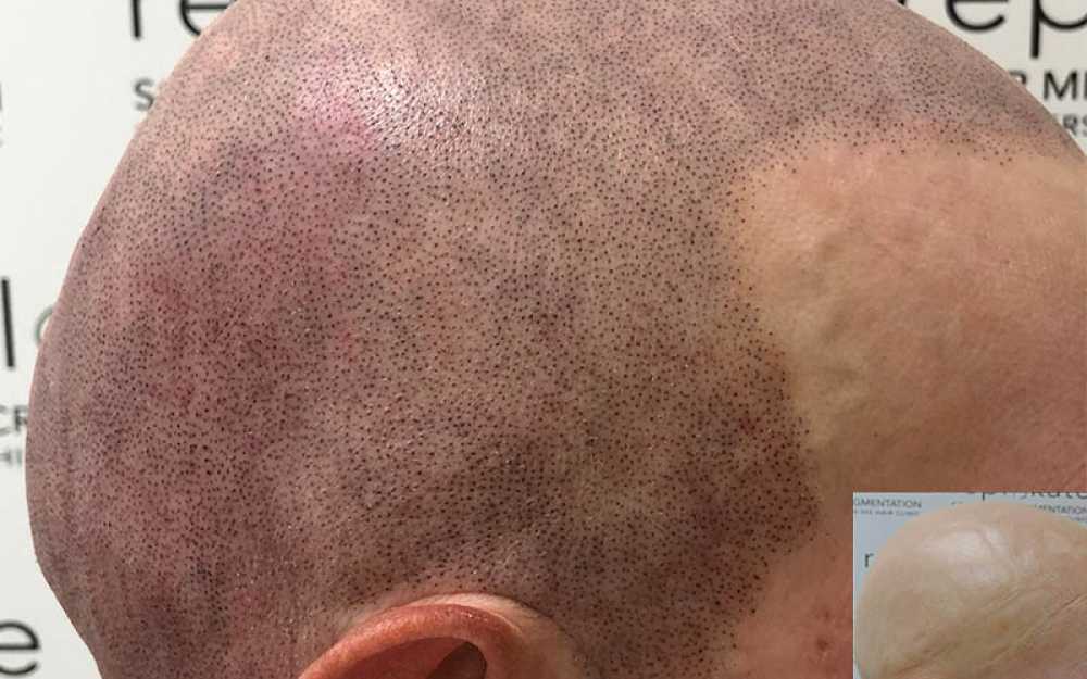 SMP Treatment for Alopecia #2