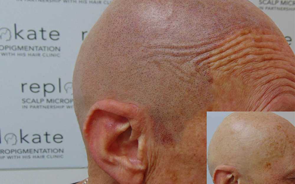 SMP Treatment for Alopecia #3