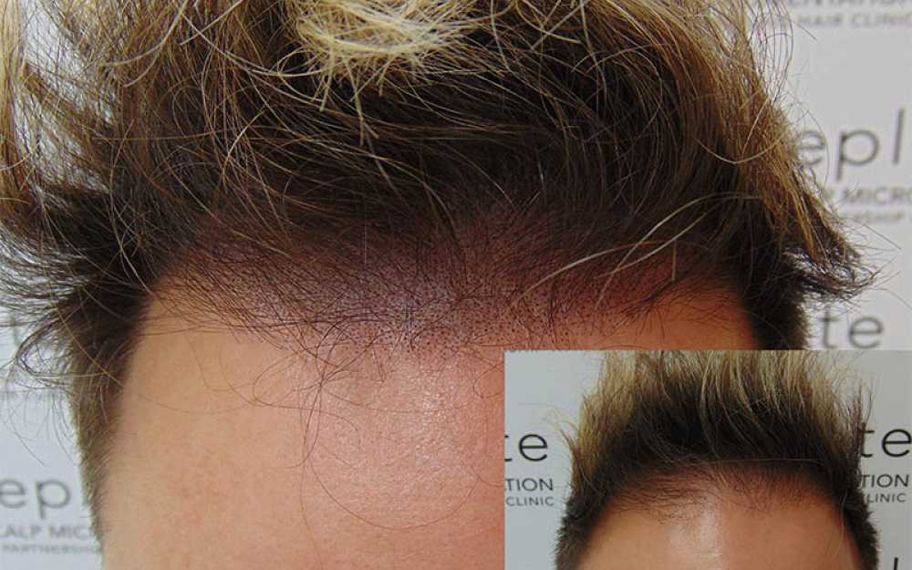 Scalp Micropigmentation to assist with receding hairlines #1
