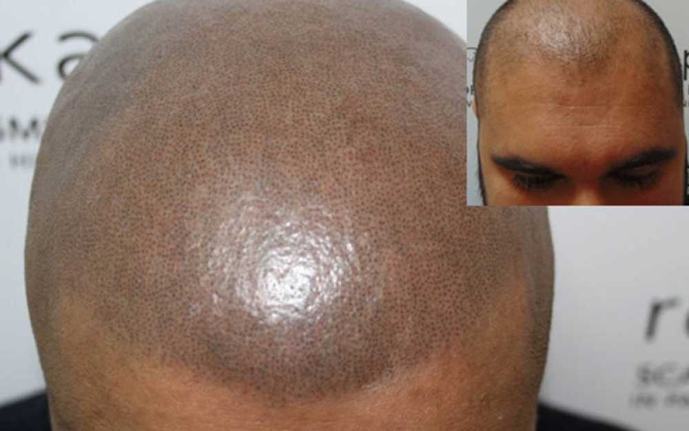 Scalp Micropigmentation to assist with receding hairlines #2