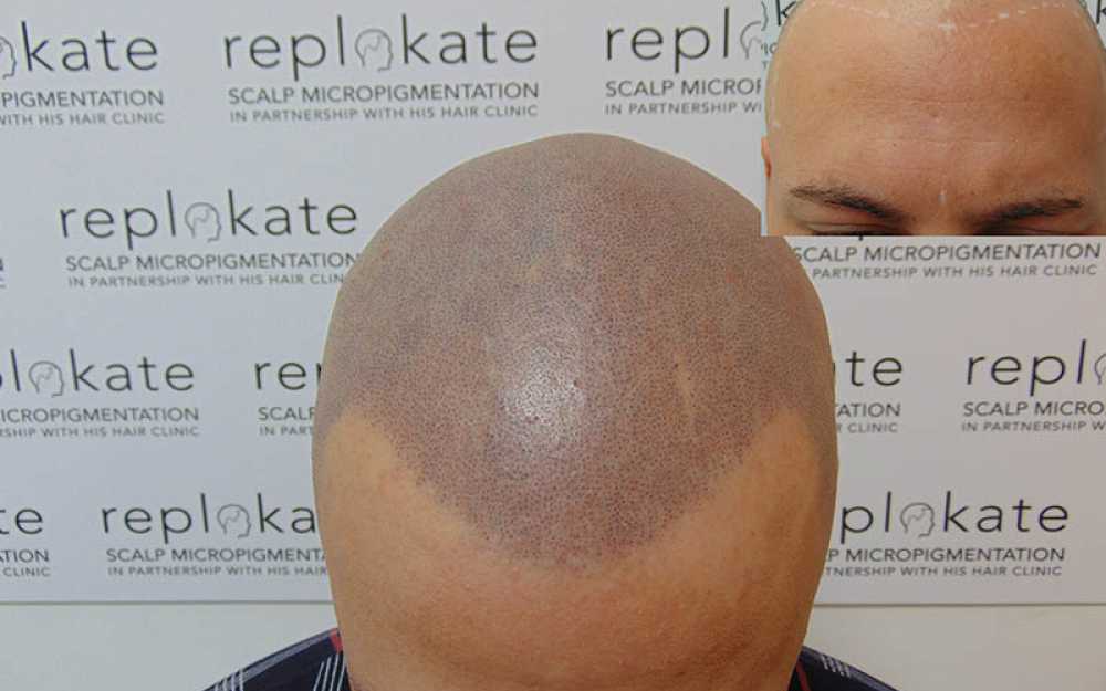 Scalp Micropigmentation to assist with receding hairlines #3