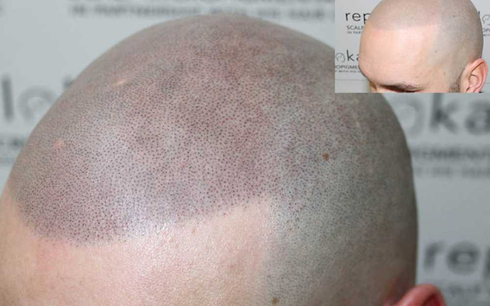 Scalp Micropigmentation to assist with receding hairlines #4