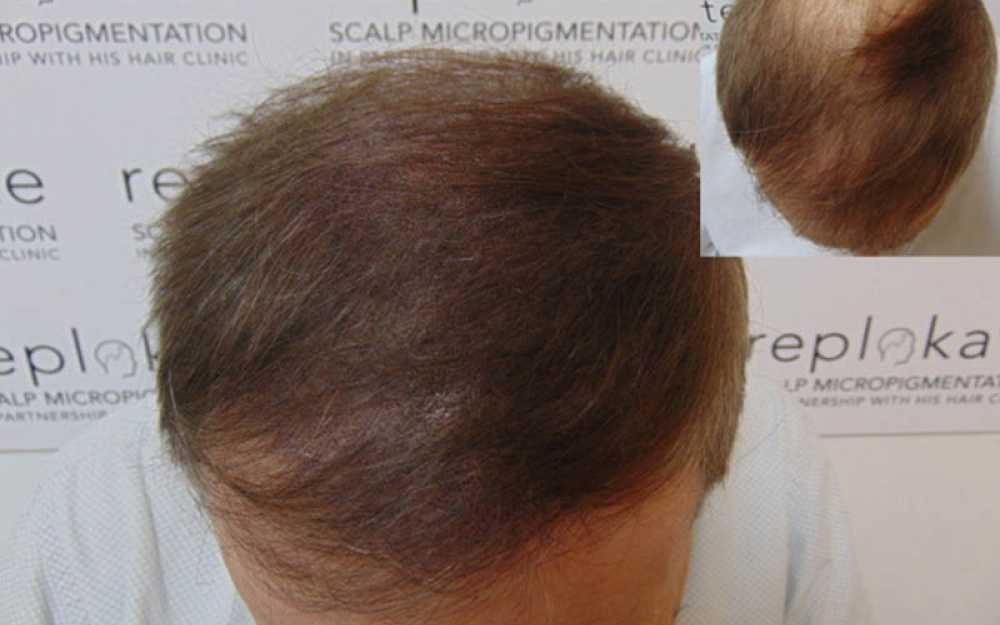 Crown Balding & Complete Hair Loss #1