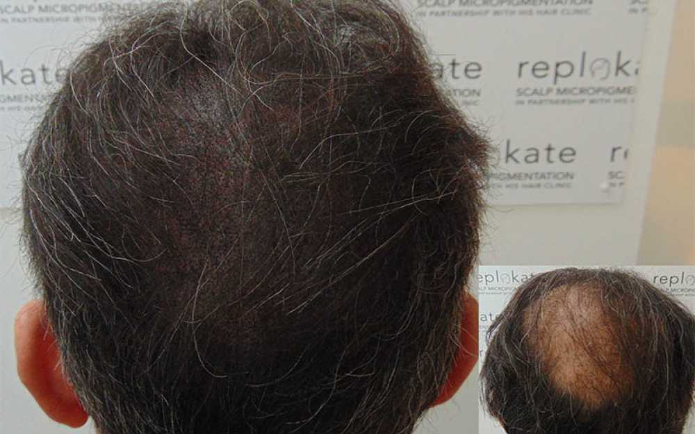 Crown Balding & Complete Hair Loss #2