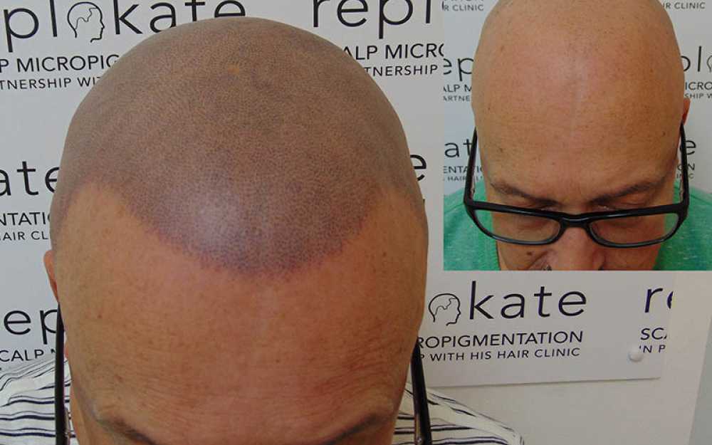 Crown Balding & Complete Hair Loss #4