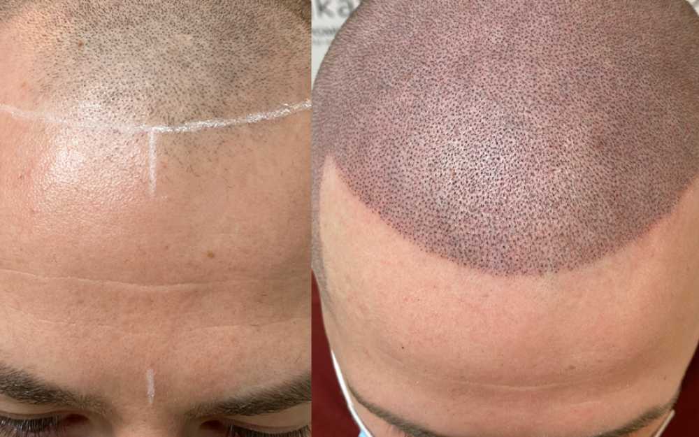 Scalp Micropigmentation #1