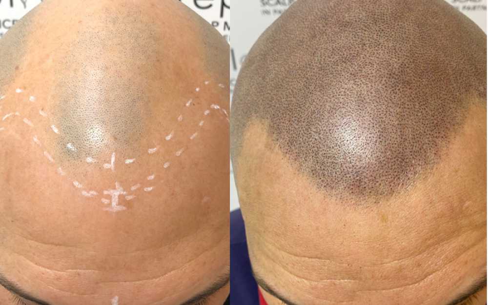 Scalp Micropigmentation #2