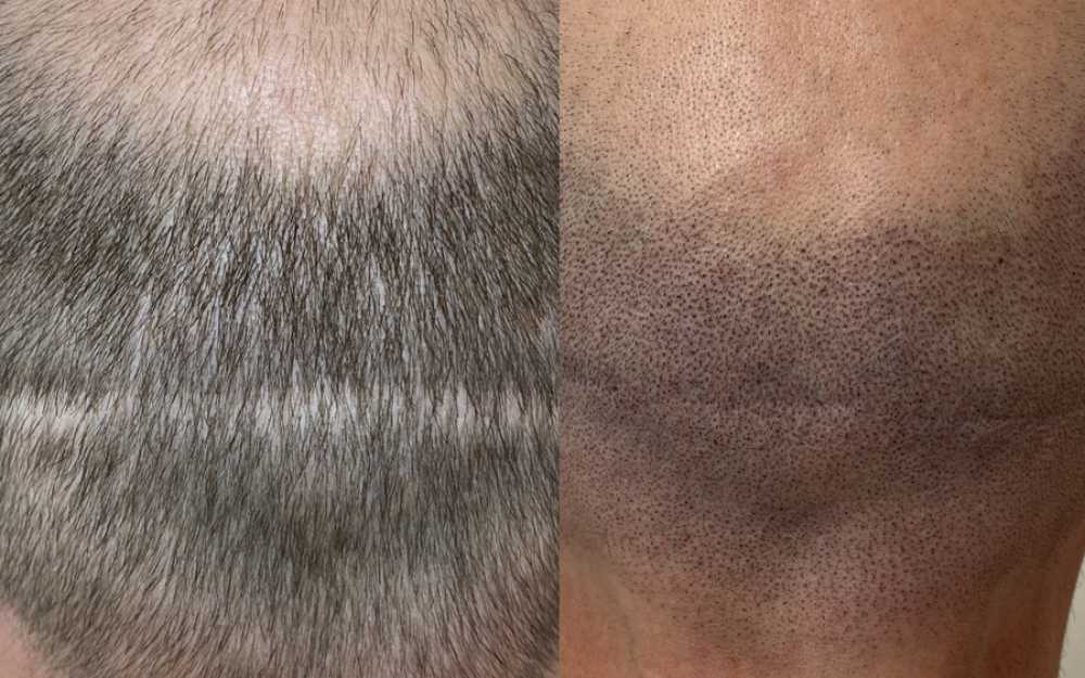 Scalp Micropigmentation #5