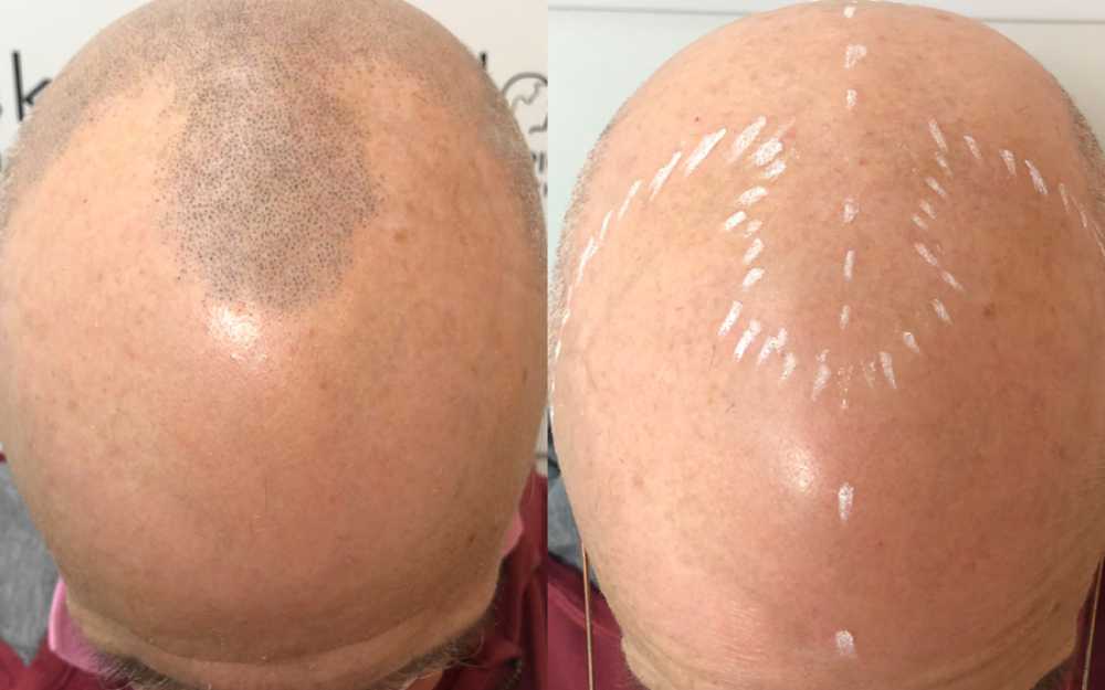 Scalp Micropigmentation #6