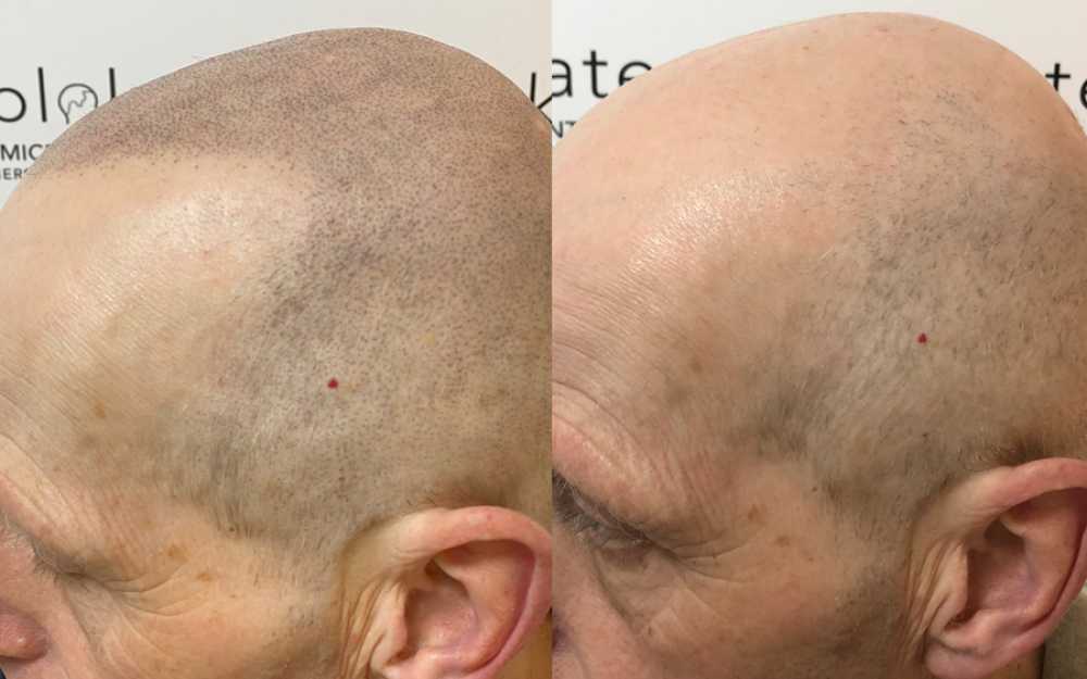 Scalp Micropigmentation #7