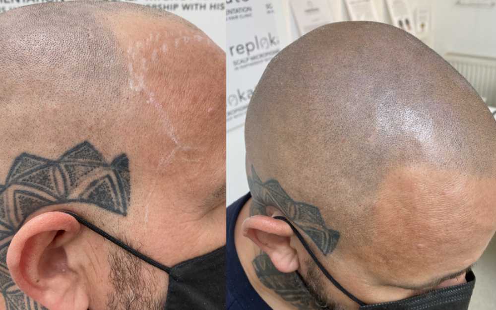 Scalp Micropigmentation #8