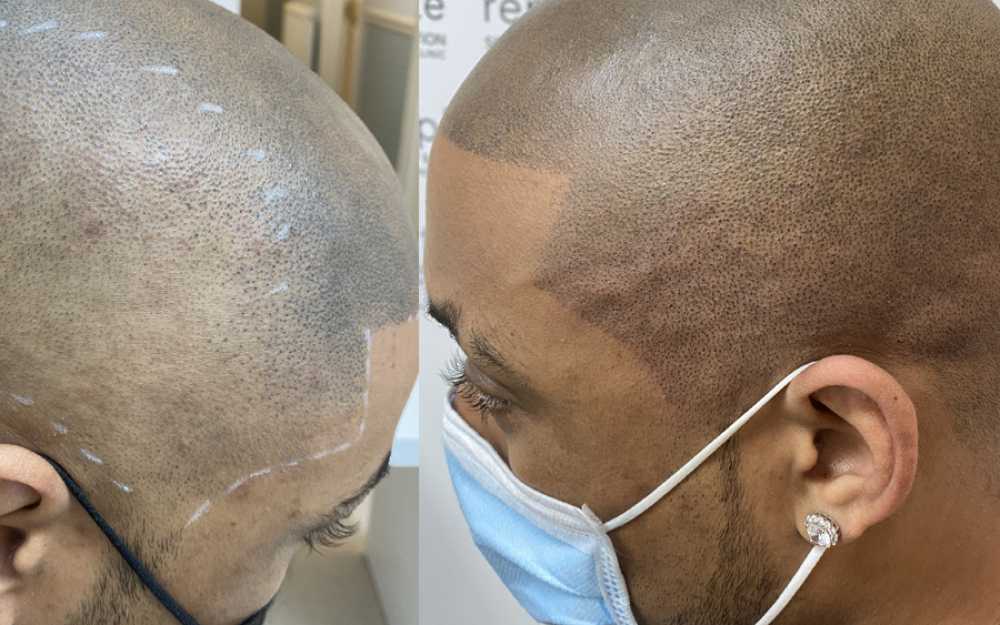 Scalp Micropigmentation #9