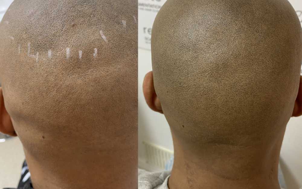 Scalp Micropigmentation #10