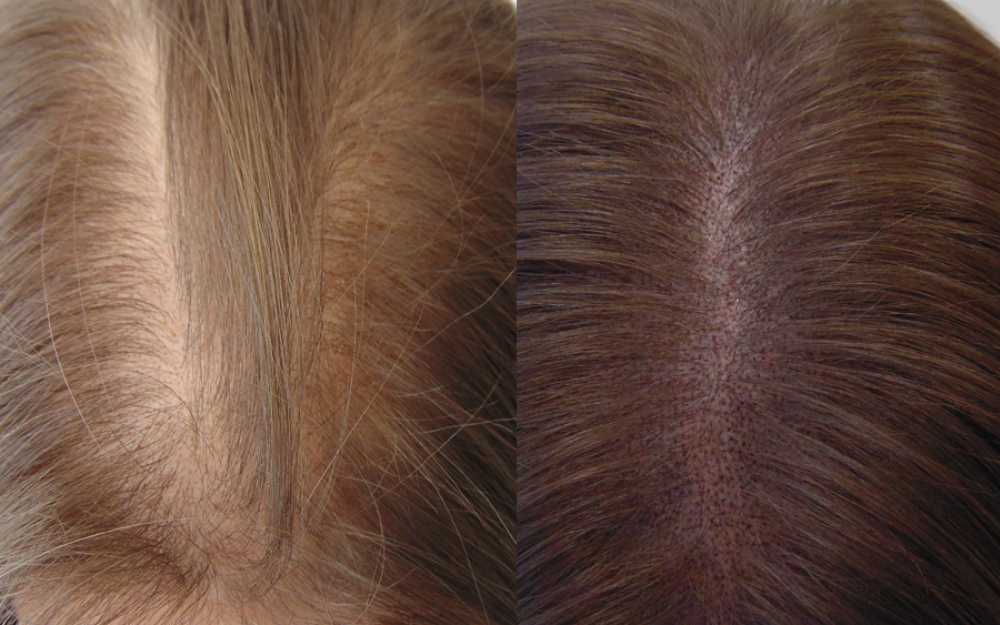 Scalp Micropigmentation #13