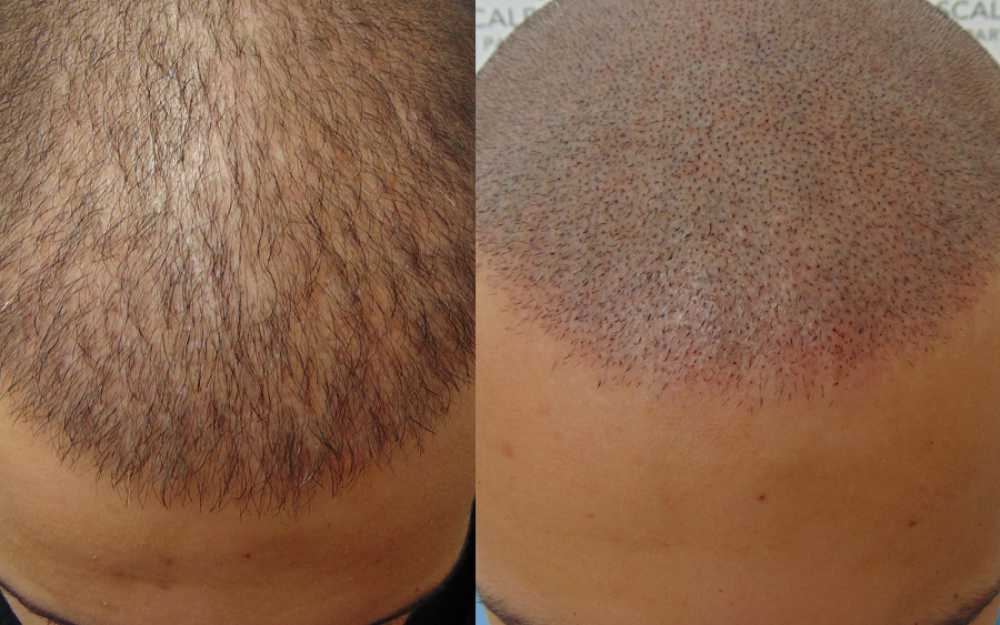 Scalp Micropigmentation #14