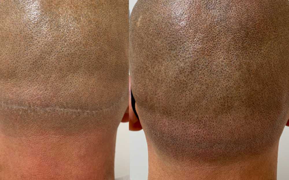 Scalp Micropigmentation #16